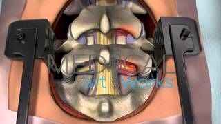 3D Medical Animation  Lumbar spine surgical procedure 2 level fusion of L4S1 [upl. by Libbna]