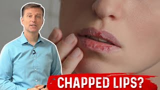 Which Vitamin Deficiency Causes Chapped  Cracked Lips – Dr Berg [upl. by Rehportsirhc]