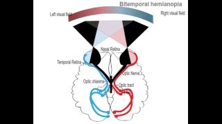 Bitemporal hemianopia [upl. by Prouty303]