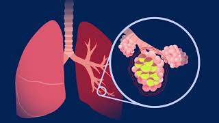 Understanding Pneumococcal Pneumonia [upl. by Ailedamla]