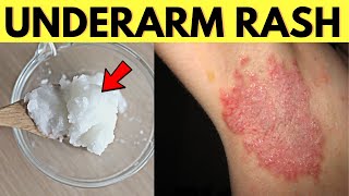 Try This Remedy To Heal Underarm Armpit Rash From Natural Deodorant [upl. by Duston783]