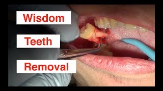 Wisdom Teeth Removal [upl. by Weinstein624]