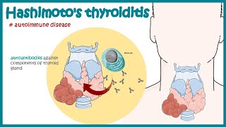 Hashimotos thyroiditis  Autoimmune diseases [upl. by Ayaet]