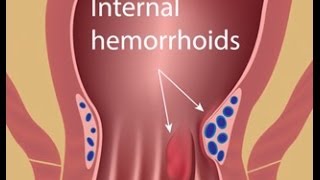 Hemorrhoid Treatment with Colorectal Surgeon Dr Jennifer Lowney [upl. by Henigman]