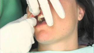 Oral Cancer Screening Exam [upl. by Nahrut]