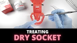 Tips For Managing Dry Socket Alveolar Osteitis  OnlineExodontiacom [upl. by Goren785]