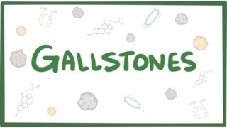 Gallstones cholelithiasis [upl. by Yentirb]