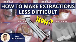 Make Extractions Less Difficult Sectioning and Elevating Teeth PDP085 [upl. by Kowal]