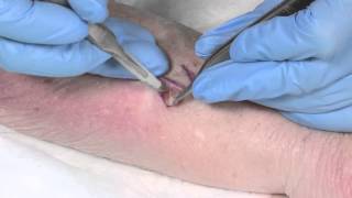 How to Suture  part 4 the Z plasty [upl. by Yrffej]