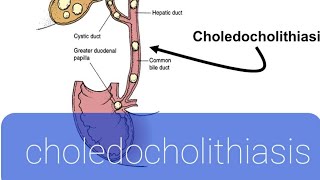 choledocholithiasis [upl. by Horbal207]