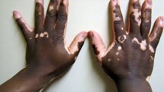 Difference Between Albinism and Vitiligo [upl. by Ajssatan]