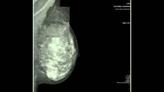 Breast Imaging Calcifications  module 2  Health4TheWorld Academy [upl. by Eileme]