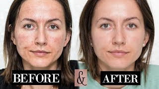 My MICRONEEDLING Experience  Skin Updates  Before amp After [upl. by Narf127]