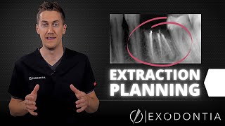 How To Extract Teeth Successfully Every Time  OnlineExodontiacom [upl. by Tepper44]