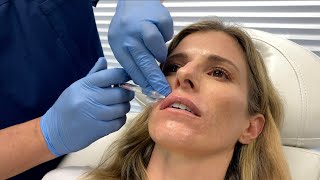 Film Starlette Cory Chase Gets Plump Lips with Restylane Kysse  OceanDrivePlasticSurgerycom [upl. by Yllut]