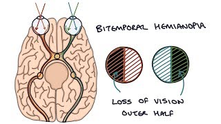 Understanding Bitemporal Hemianopia [upl. by Nahallac209]