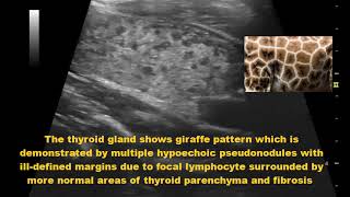 Hashimoto’s Thyroiditis Ultrasound giraffe pattern [upl. by Atnod]