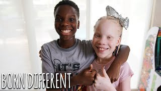 My Twin Sister Has Albinism  BORN DIFFERENT [upl. by Hcnarb]