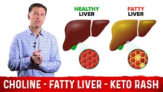 Choline One of The Best Vitamins for Fatty Liver – Dr Berg [upl. by Seuqram795]