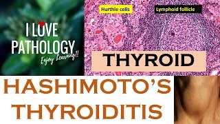 HASHIMOTOS THYROIDITIS Etiopathogenesis Morphology amp Complications [upl. by Atinrev747]