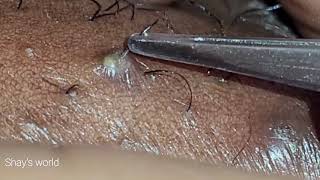 INGROWN HAIR REMOVAL 14 [upl. by Rosmarin]