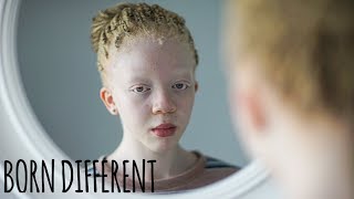 I’m Black Even With Albinism  BORN DIFFERENT [upl. by Bastian]