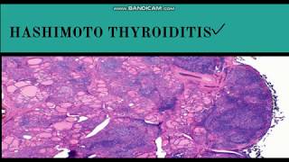 HASHIMOTOS Thyroiditis 5 Things YOU Need to Know 2024 [upl. by Yebloc]