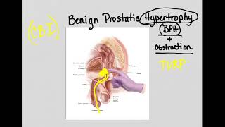 Urinary Obstruction and BPH [upl. by Airahcaz152]