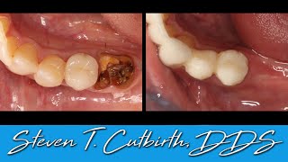 Sectioning and Extraction of Mandibular Molar Grafting with PRF  with Steven T Cutbirth DDS [upl. by Eerej112]