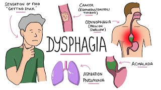 Dysphagia  Oropharyngeal amp Esophageal Dysphagia CausesDifferential Diagnosis Signs Treatment [upl. by Tihom]