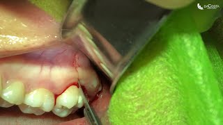 Exodontia de terceiro molar superior Upper wisdom tooth extraction [upl. by Power]