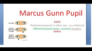 Ophthalmology Marcus Gunn Pupil RAPD Relative Afferent Pupillary Pathway Defect [upl. by Sacks]