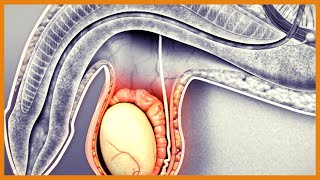 Hydrocele vs Varicocele vs Torsion vs Epididymitis vs Tumor [upl. by Solrac781]