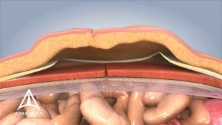 Ventral Hernia Repair  3D Medical Animation [upl. by Krauss732]