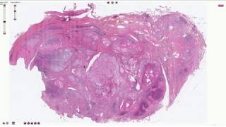 Hashimoto Thyroiditis  Histopathology [upl. by Aisatnaf859]