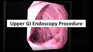 Upper GI Endoscopy Procedure in the ED [upl. by Mercie]