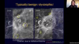 UCSF Radiology Calcium Scoring vs Coronary CTA Scan [upl. by Aierdna51]