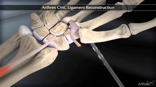 Arthrex CMC Ligament Reconstruction [upl. by Alor]