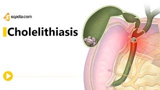 Cholelithiasis II  Gastroenterology Medicine Animation  Medical VLearning [upl. by Bremer]